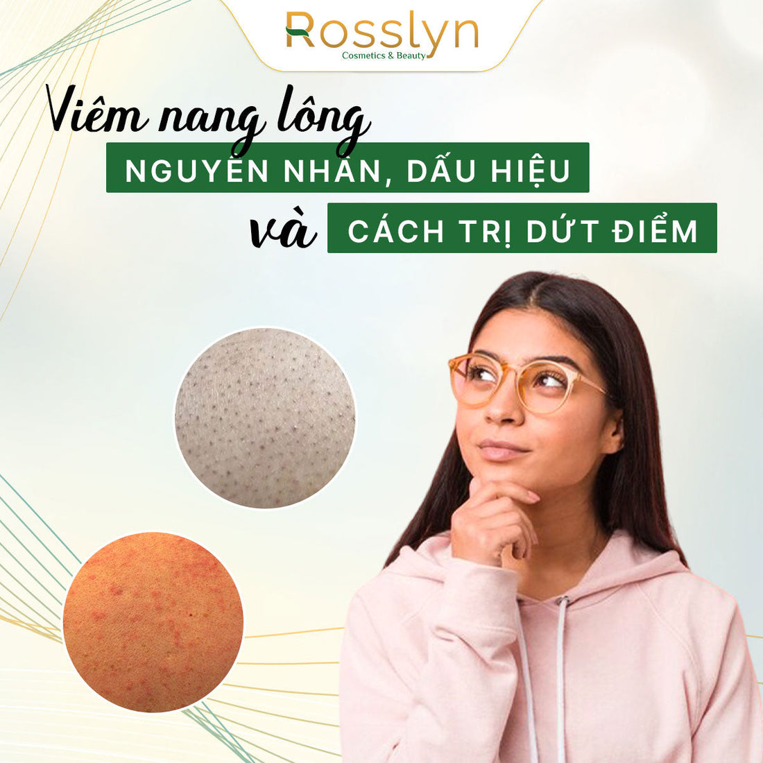 Viêm nang lông: Nguyên nhân, dấu hiệu và cách trị dứt điểm